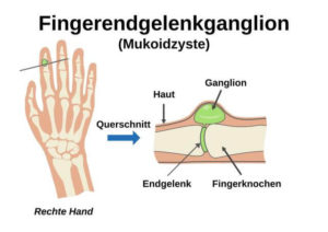 Ganglion Berbein Alles Wissenswerte Von Definition Bis Zur Behandlung