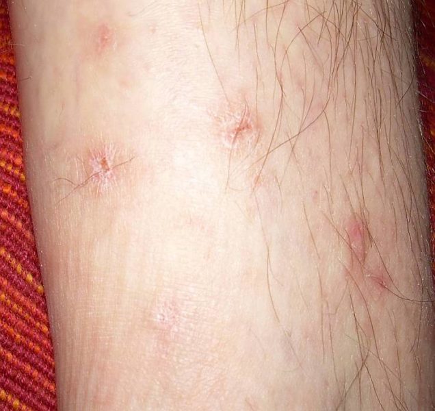 Дерматит на ноге после 10 применений лечебной грязью Sivash-Heilerde